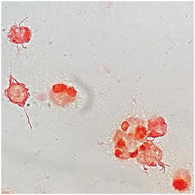 Septic arthritis complicating Streptobacillus moniliformis rat bite fever: a case report and review of its pathophysiology and diagnosis